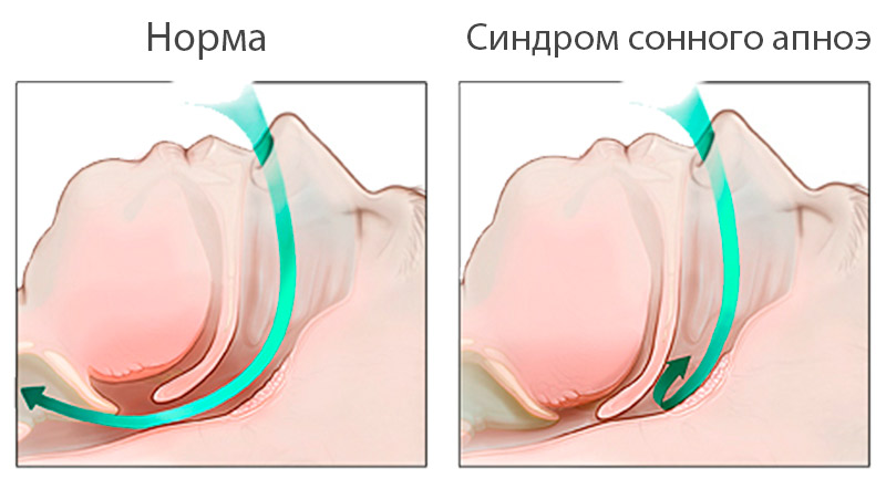Дыхание при апноэ характеризуется периодическими остановками или сильным затруднением дыхания во сне, что приводит к падению уровня кислорода в крови